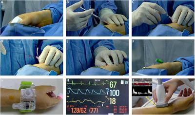 Early prevention of radial artery occlusion via distal transradial access for primary percutaneous coronary intervention